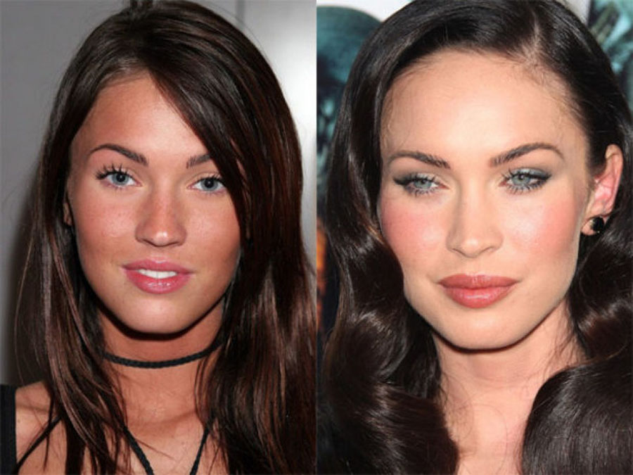 gorgeous-stars-before-and-after-botox-05