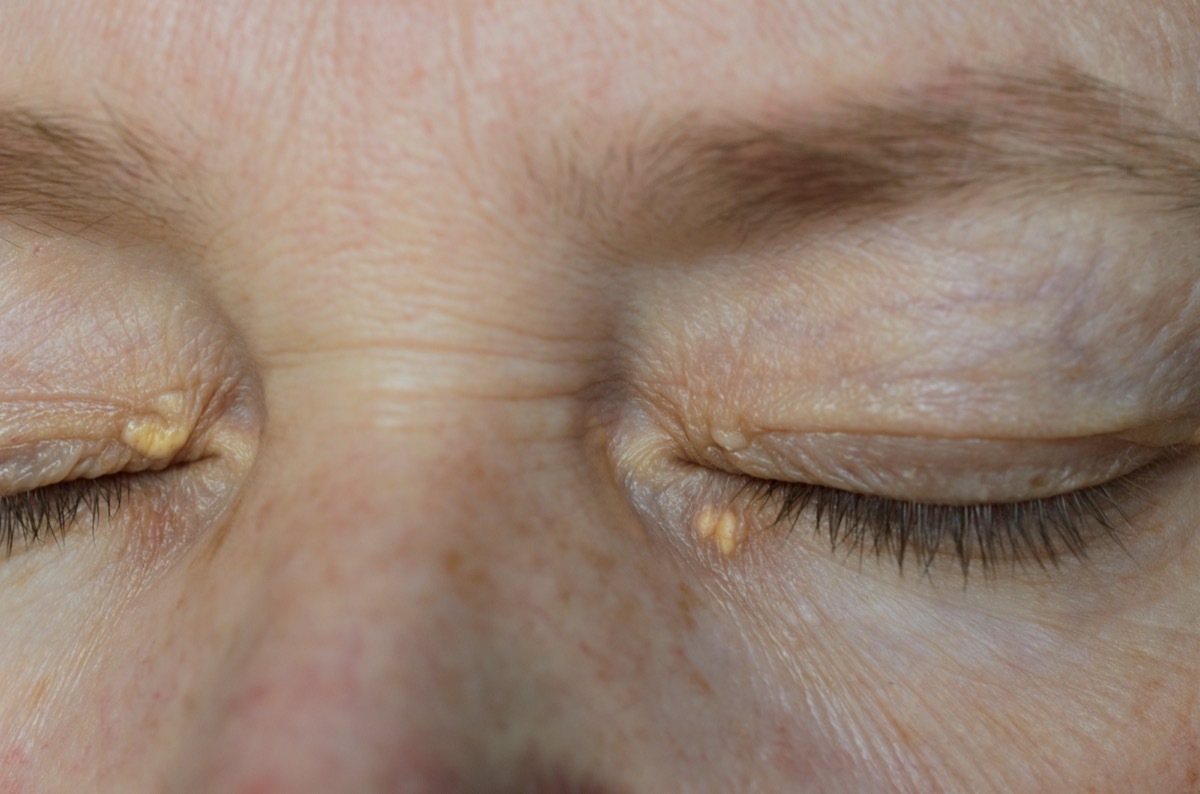 woman eyes with Xanthelasma on the eyelids. Hypercholesterolemia, high cholesterol