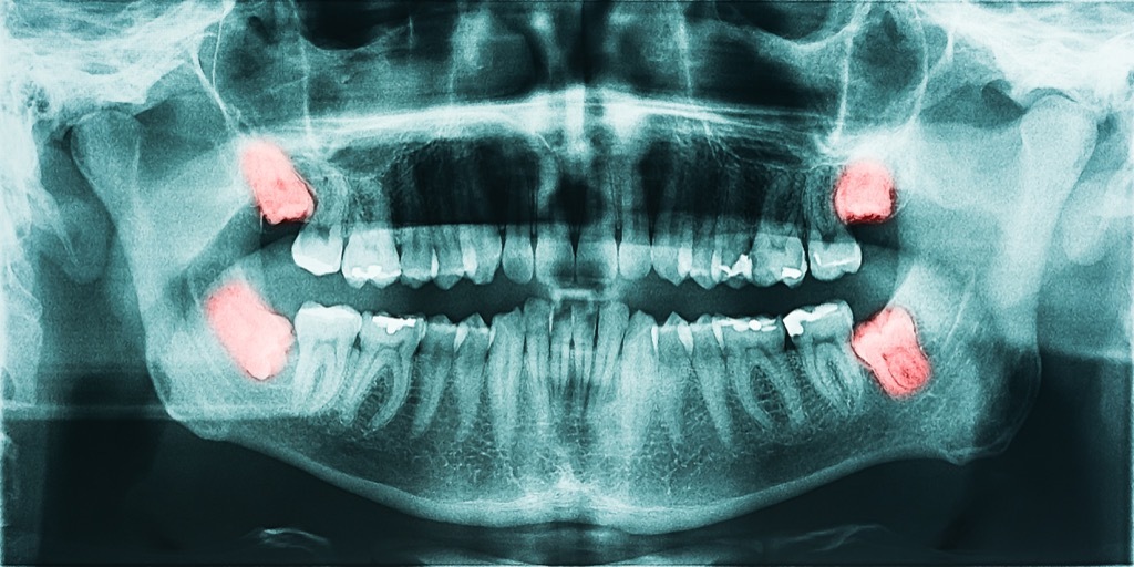 Mouth Xray