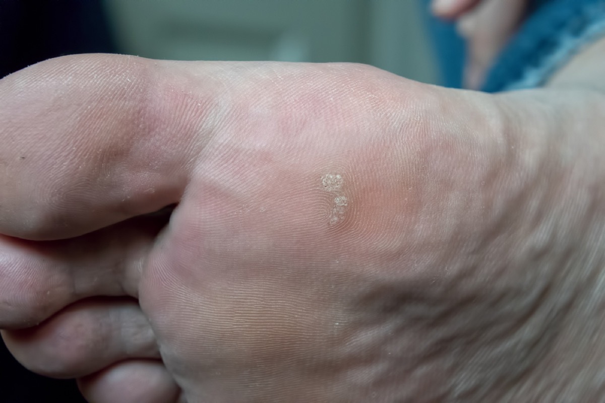 older man's foot with warts, contagious conditions